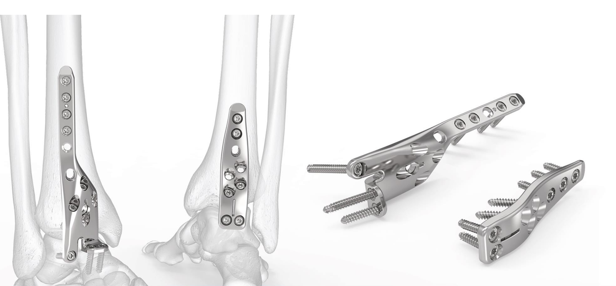 Extremilock <br> ankle fusión plating system